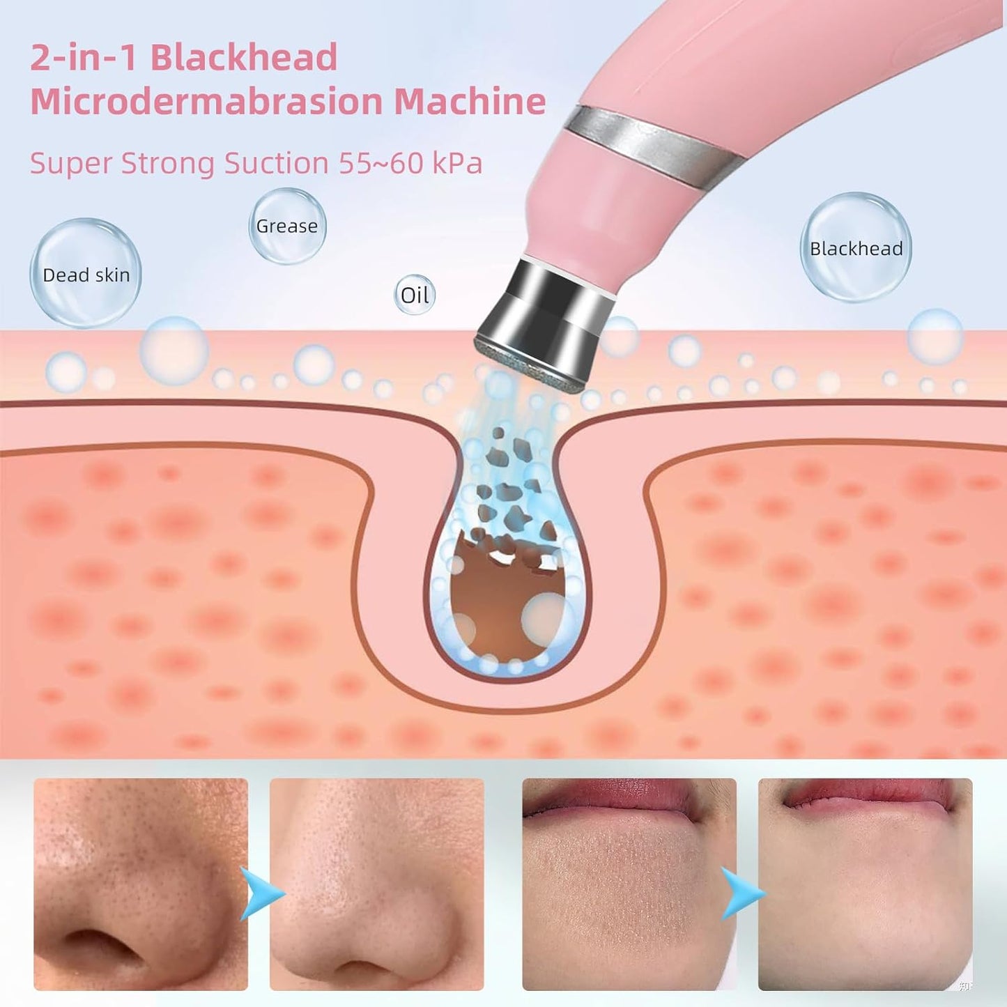 DiamondSkin™ - Blackhead & Exfoliation Machine